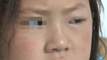 5岁女孩把502胶水滴进自己左眼